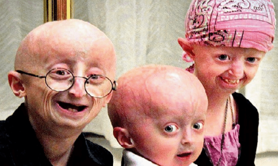 Progeria De Hutchinson Gilford Bildirchinaz